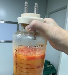 德清水动力吸脂手术要做多久？